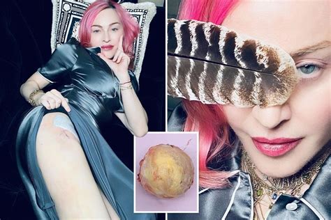 Madonna Fans Convinced She Has Undergone Hip Replacement After Star