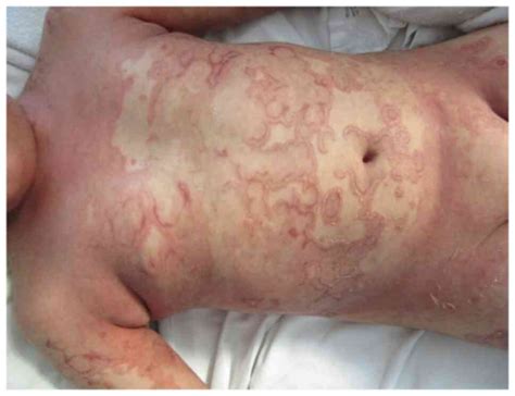 Management Of Psoriasis In Children Review