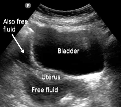 Pelvic Ultrasound Pelvic Free Fluid