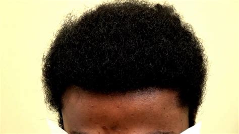 Hair transplant cost and price of a receding hairline. Black Man Hair Transplant 2 Year Follow Up with Before and ...