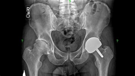 Minimally Invasive Direct Anterior Birmingham Hip Resurfacing Bhr