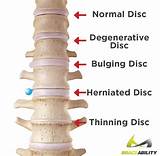 Best Treatment For Herniated Disc In Neck Photos