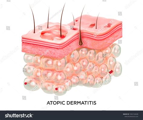 9729 Atopic Dermatitis Images Stock Photos And Vectors Shutterstock