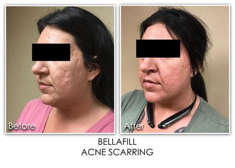 15 Dermal Filler Acne Scarring Skin Rejuvenation Clinic Skin