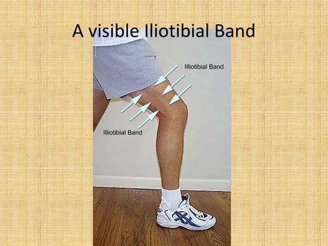 Ppt Iliotibial Band Syndrome Powerpoint Presentation Free Download