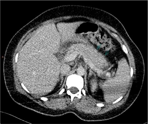 Axial C Portal Venous Phase Showing A Mild Swelling Of The Pancreas