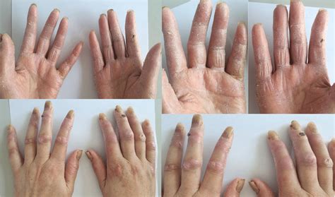 Severe Hand Foot Syndrome In The Patient After The Fourth Cycle Of