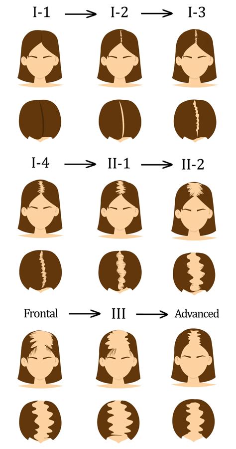Female Pattern Baldness Female Pattern Hair Loss Solutions Hair Doc