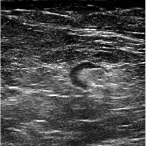 B Ultrasound Image Of The Same Patients Right Axillary Region At