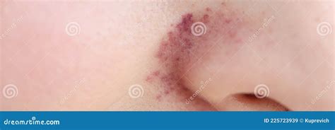 Rash On Skin Near Woman Nose Closeup Stock Image Image Of Dermatosis