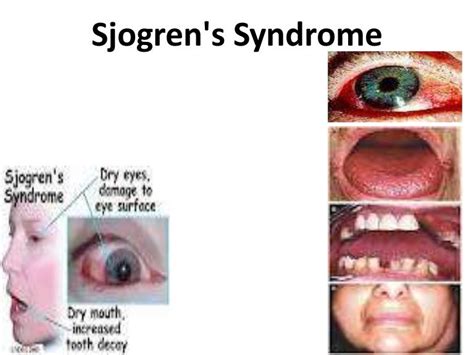 Sjogrens Syndrome