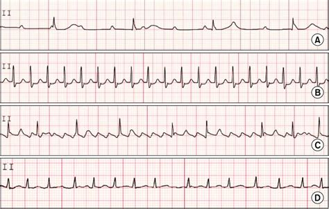 Atrial Flutter With Variable Block