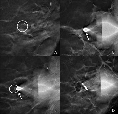 Digital Breast Tomosynthesis Dbt Guided Biopsy Of Calcifications