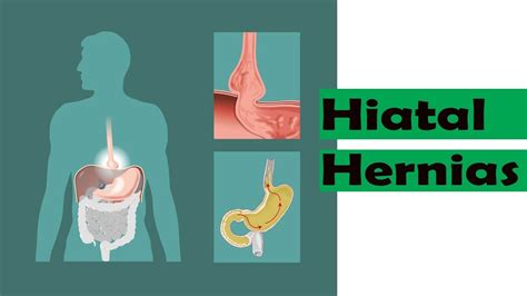 No More Hiatal Hernias Use This Simple Remedies Naturally At Home Youtube