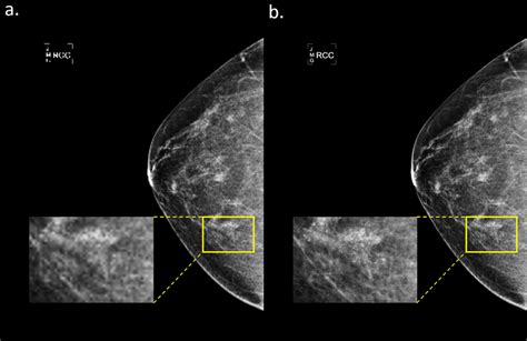 Mammograms With Microcalcification In Two Different Resolutions The Download Scientific