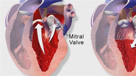 Real Men Wear Gowns Difficulties With The Mitral Valve