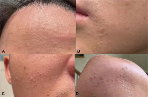 20 Year Old Patient With Diffusely Distributed Facial Flat Warts That