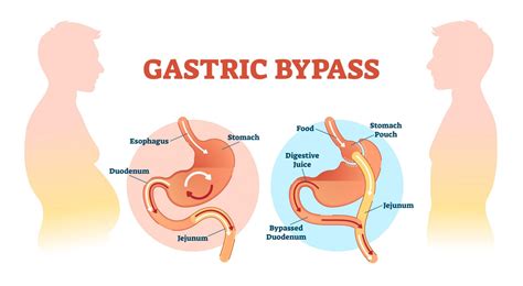 Gastric Bypass Surgery Perth Bariatric Surgeon Stomach Bypass