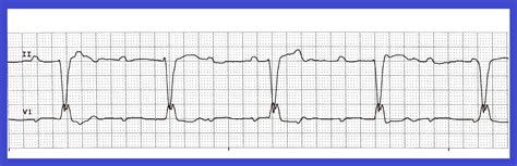 Sometimes a disorder can be inherited. Float Nurse: Heart Block Quiz 299