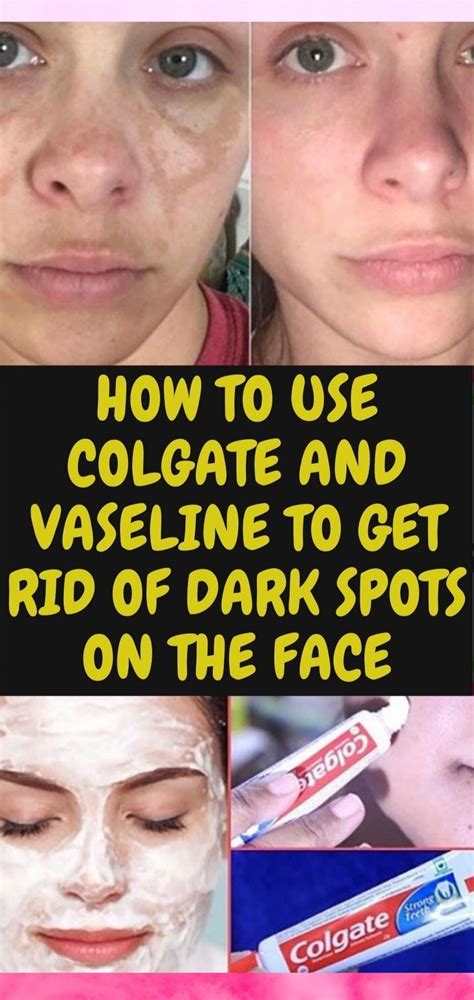 How To Use Colgate And Vaseline To Get Rid Of Dark Spots On The Face
