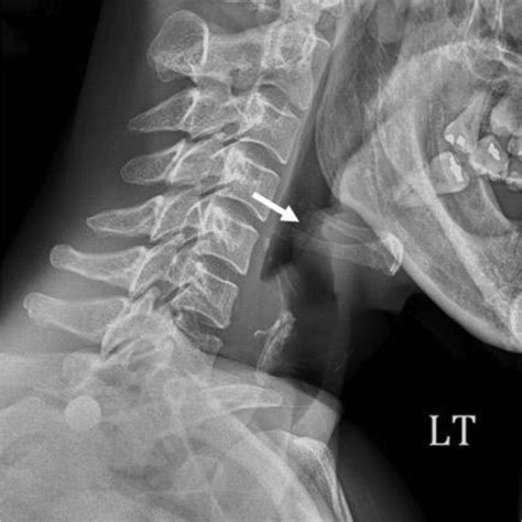 Lateral Soft Tissue Neck Radiograph Showing A Lobulated Enlarged