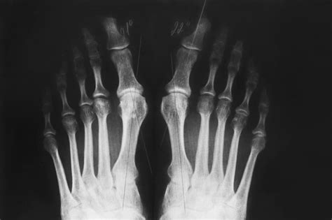 Premium Photo X Ray Of The Foot Valgus Deformity Of The Toe