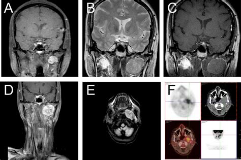 The Natural History Of Parapharyngeal Solitary Fibrous Tumor