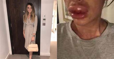 Botox Gone Wrong Woman S Lips Swell Thrice The Normal Size After Getting Lip Fillers