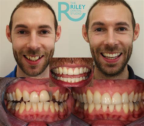 Can teeth aligners fix overbites? Riley Dental Studio - Invisalign Stoke on Trent