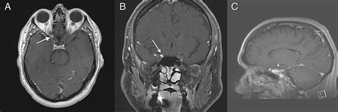 Cureus A Rare Case Of Optic Nerve Schwannoma Case Report And Review