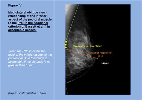 Mammography Image Quality Model For Predicting Compliance With
