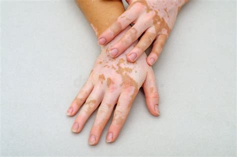 Vitiligo On The Skin Of Hands Stock Photo Image Of Back Care 155933700