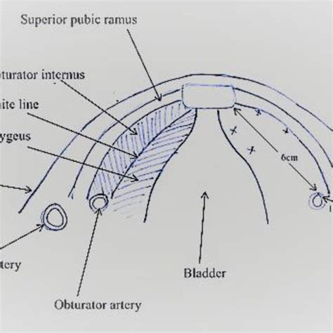 Schematic Presentation Of Anatomy And Suture Placement In Burch Download Scientific Diagram