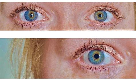 Central Heterochromia Definition Causes And Types Central