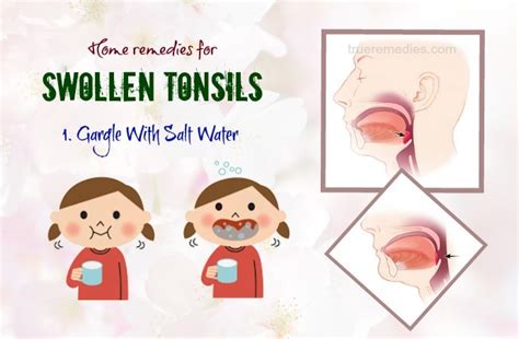 Swollen Tonsils No Pain