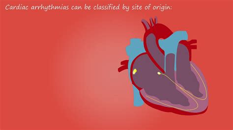 Heart Arrhythmia Heart Arrhythmia Also Known As Irregular Flickr