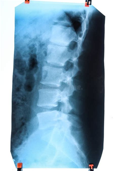 X Rayo De La Espina Dorsal Lumbar Espina Dorsal En Radiografía Imagen