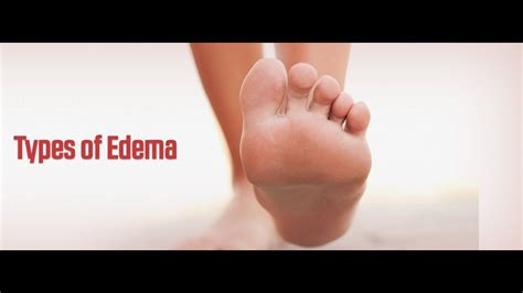 8 Types Of Edema Youtube
