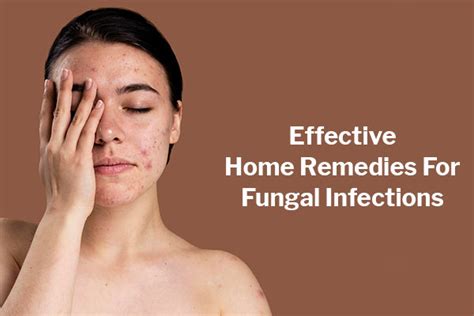 12 Effective Home Remedies For Fungal Infections