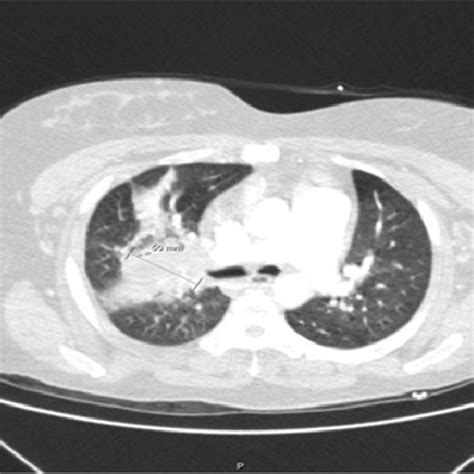 Ct Angiography Of The Chest Performed At The Time Of Admission Showing