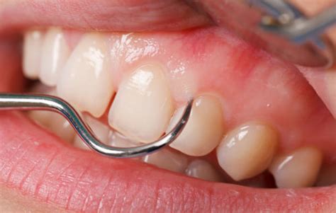 White Gums Common Causes And Prevention Tips