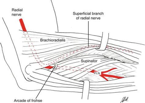 Nerve Compression In The Upper Limb Springerlink