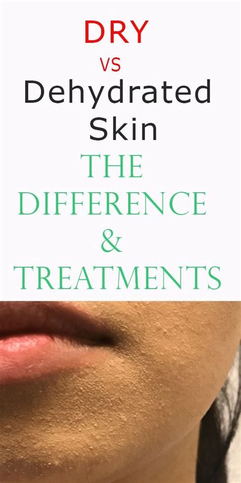 Dry Vs Dehydrated Skin The Difference And Treatments Skintreatments In