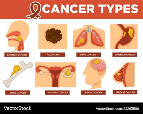 Cancer Types Poster With Kinds Of Disease Vector Image