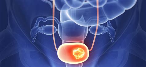 The Fascinating Story Behind A New Bladder Cancer Treatment Johnson