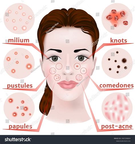 Girls Face Skin Disease Infographic Types Stock Illustration 2067248693