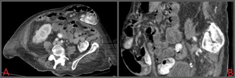 A Axial Ct Image Of The Ventral Hernia Defect B Sagittal Ct Image Of