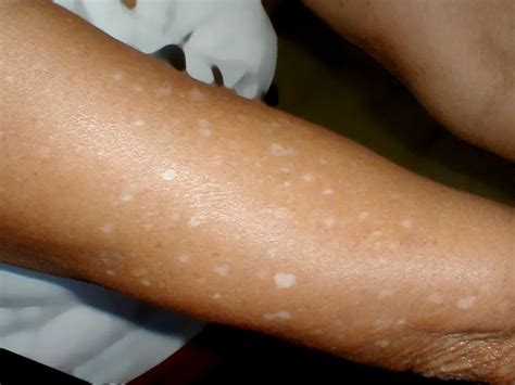 White Spots On The Skin From Sun Exposure Causes Treatment And