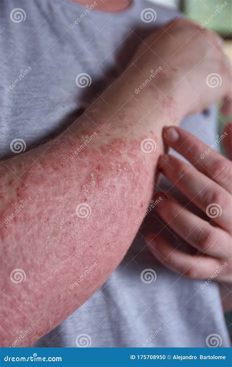 Forearm View With Psoriasis Stock Photo Image Of Elbow Immune 175708950