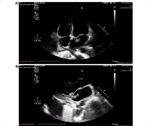 Echocardiogram Showing Two Mitral Valve Vegetations A Anterior Leaflet